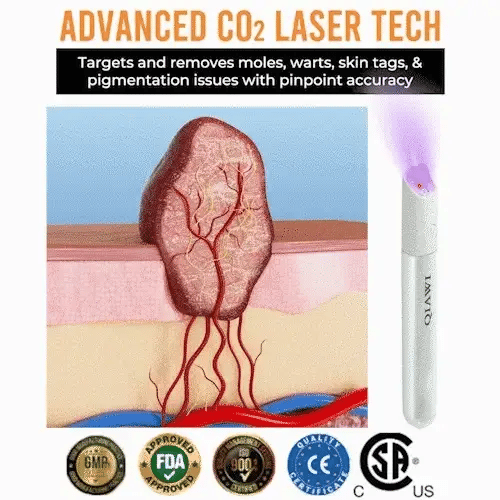 Instant Flawless Skin Laser Pen for Mole and Wart Removal